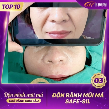 ĐỘN RÃNH MŨI MÁ